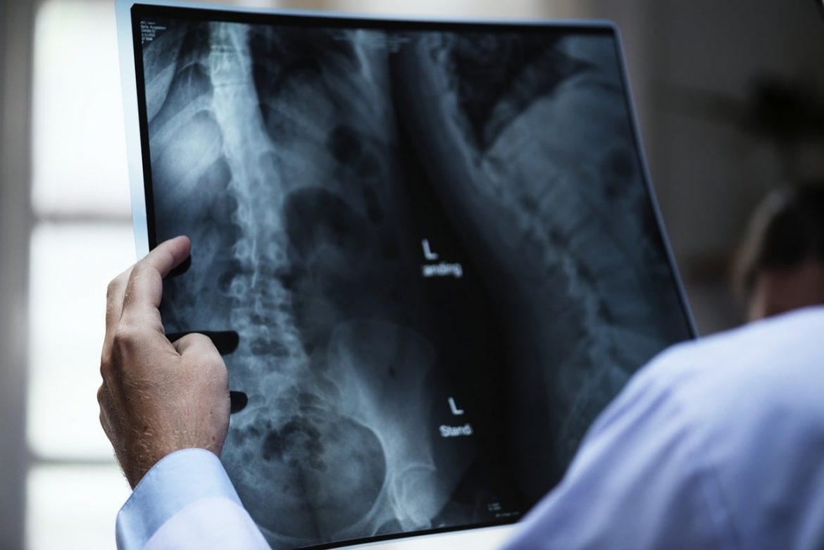 bone health The Blood Glucose and Bone Health Connection